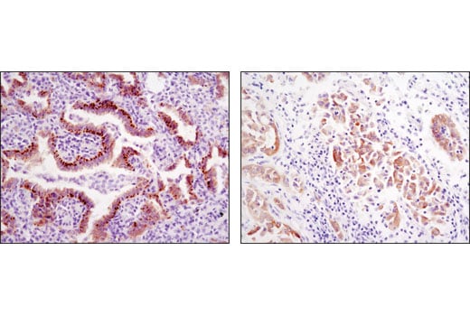 Immunohistochemistry Image 2: ROS1 (D4D6) Rabbit Monoclonal Antibody