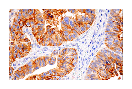 Immunohistochemistry Image 2: HER2/ErbB2 (D8F12) Rabbit Monoclonal Antibody (BSA and Azide Free)