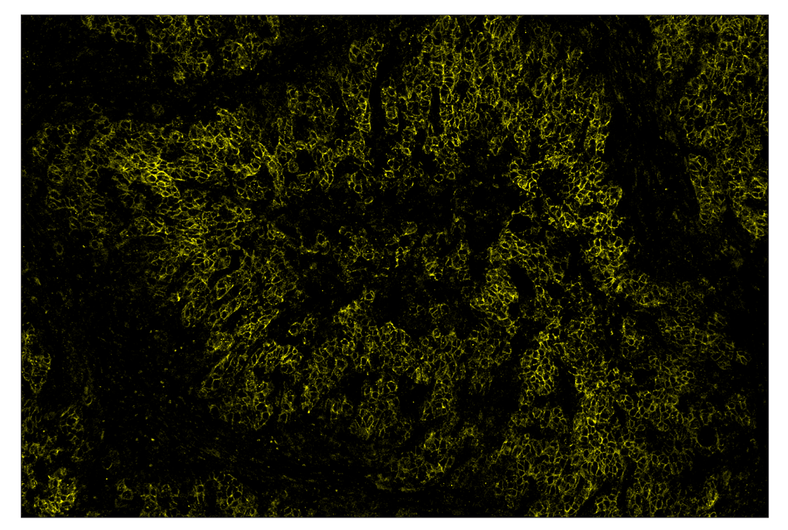 Immunohistochemistry Image 3: HER2/ErbB2 (D8F12) & CO-0059-647 SignalStar<sup>™</sup> Oligo-Antibody Pair
