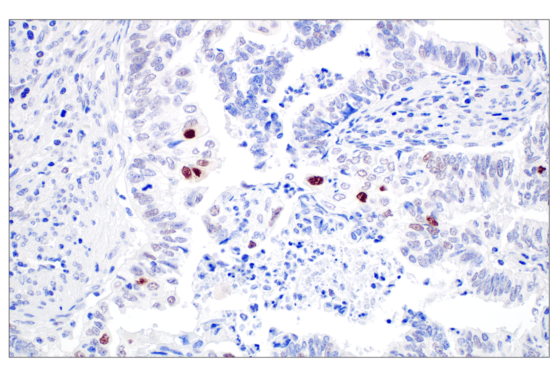Immunohistochemistry Image 3: MDM2 (F7W7X) Rabbit Monoclonal Antibody (BSA and Azide Free)