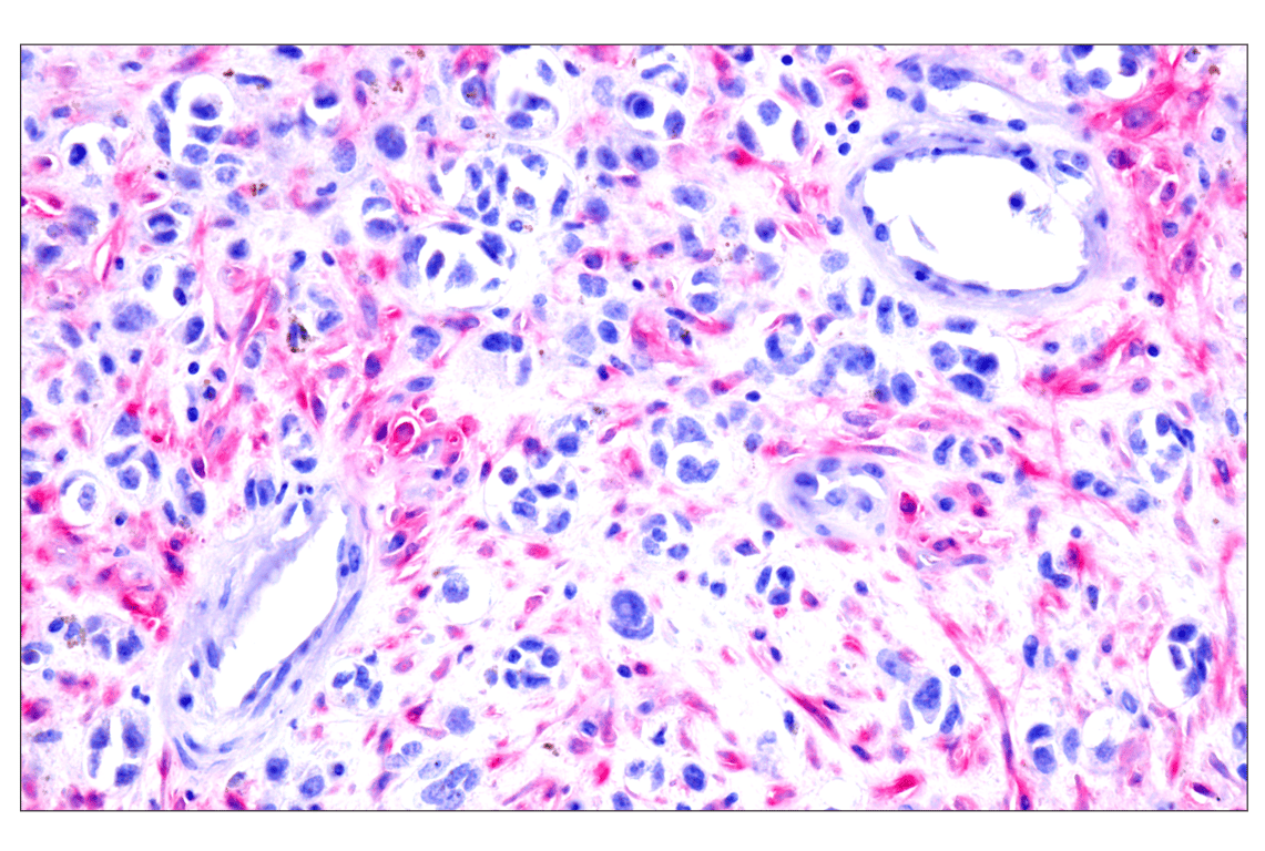 Immunohistochemistry Image 12: FAP (F1A4G) Rabbit Monoclonal Antibody