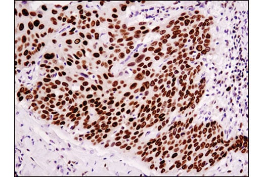 Immunohistochemistry Image 1: HMGA1 (D4F8) Rabbit Monoclonal Antibody