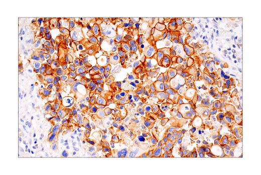 Immunohistochemistry Image 1: HER2/ErbB2 (D8F12) Rabbit Monoclonal Antibody (BSA and Azide Free)