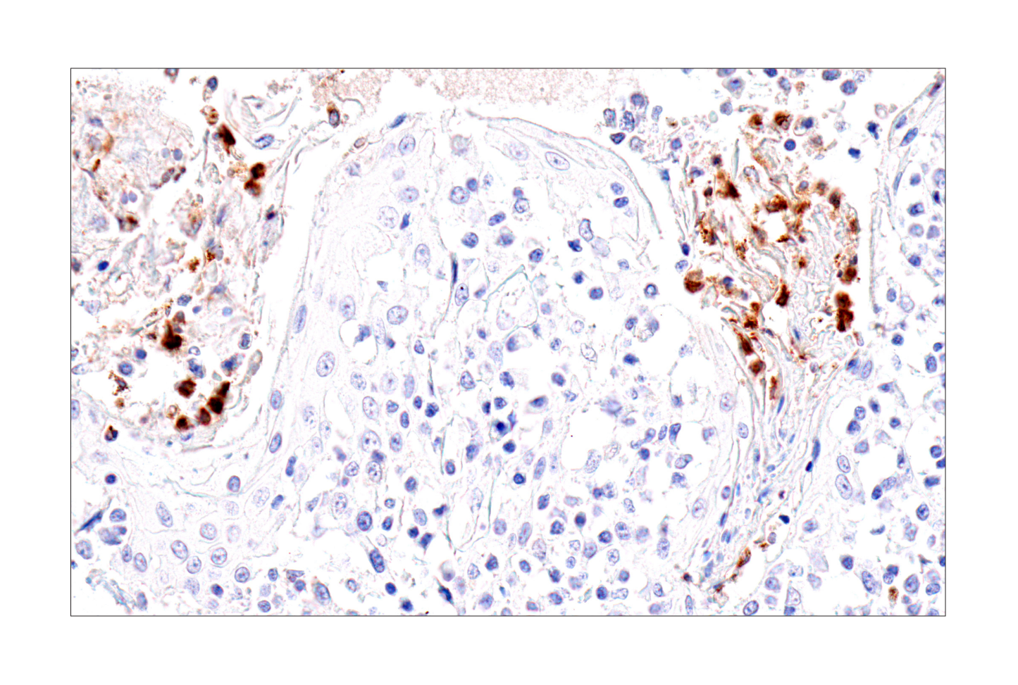 Immunohistochemistry Image 1: IL-8 (E5F5Q) XP® Rabbit mAb (BSA and Azide Free)