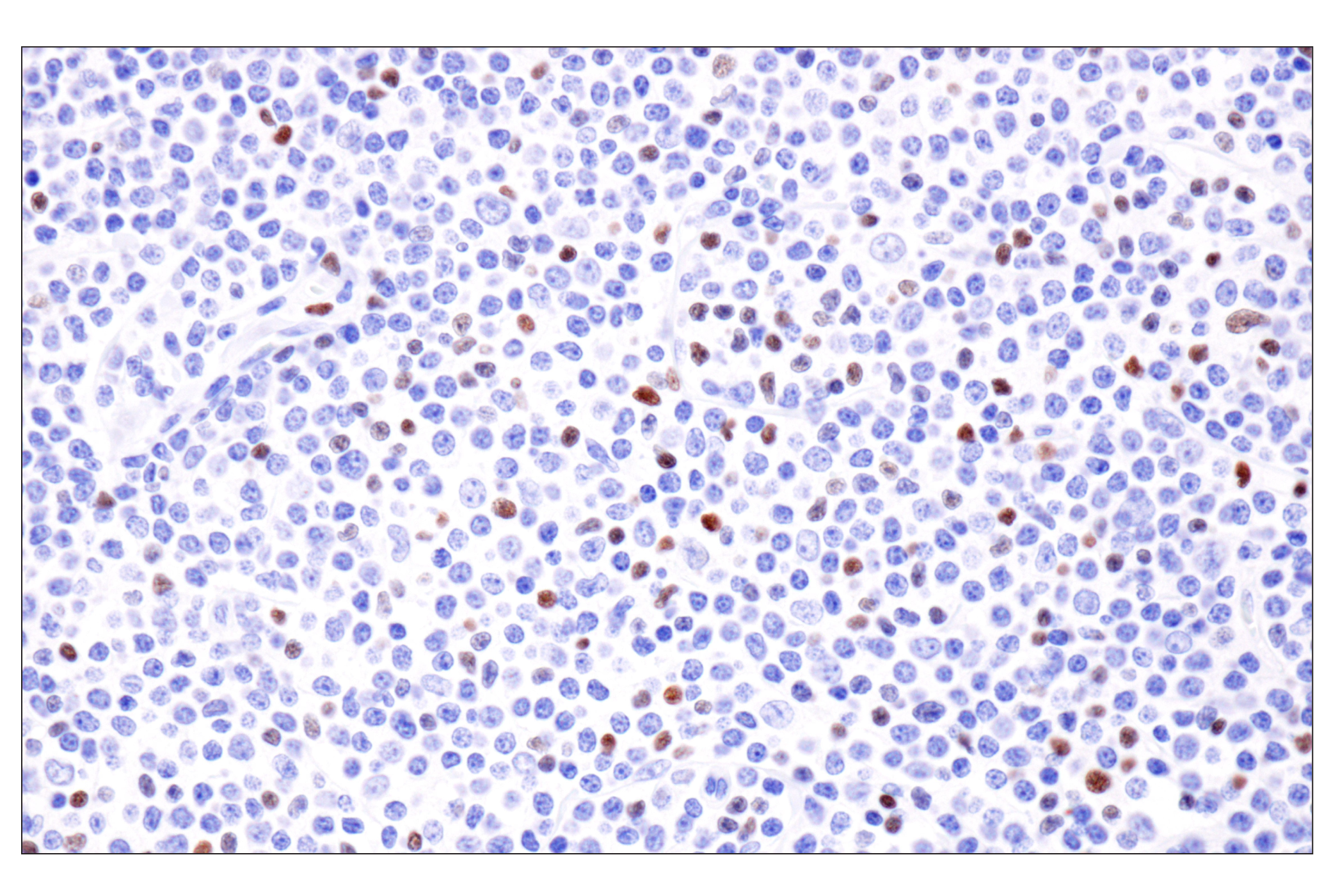 Immunohistochemistry Image 1: FoxP3 (221D) Mouse Monoclonal Antibody