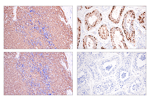 Immunohistochemistry Image 5: SSX (E5A2C) Rabbit mAb (Carboxy-terminal Antigen)