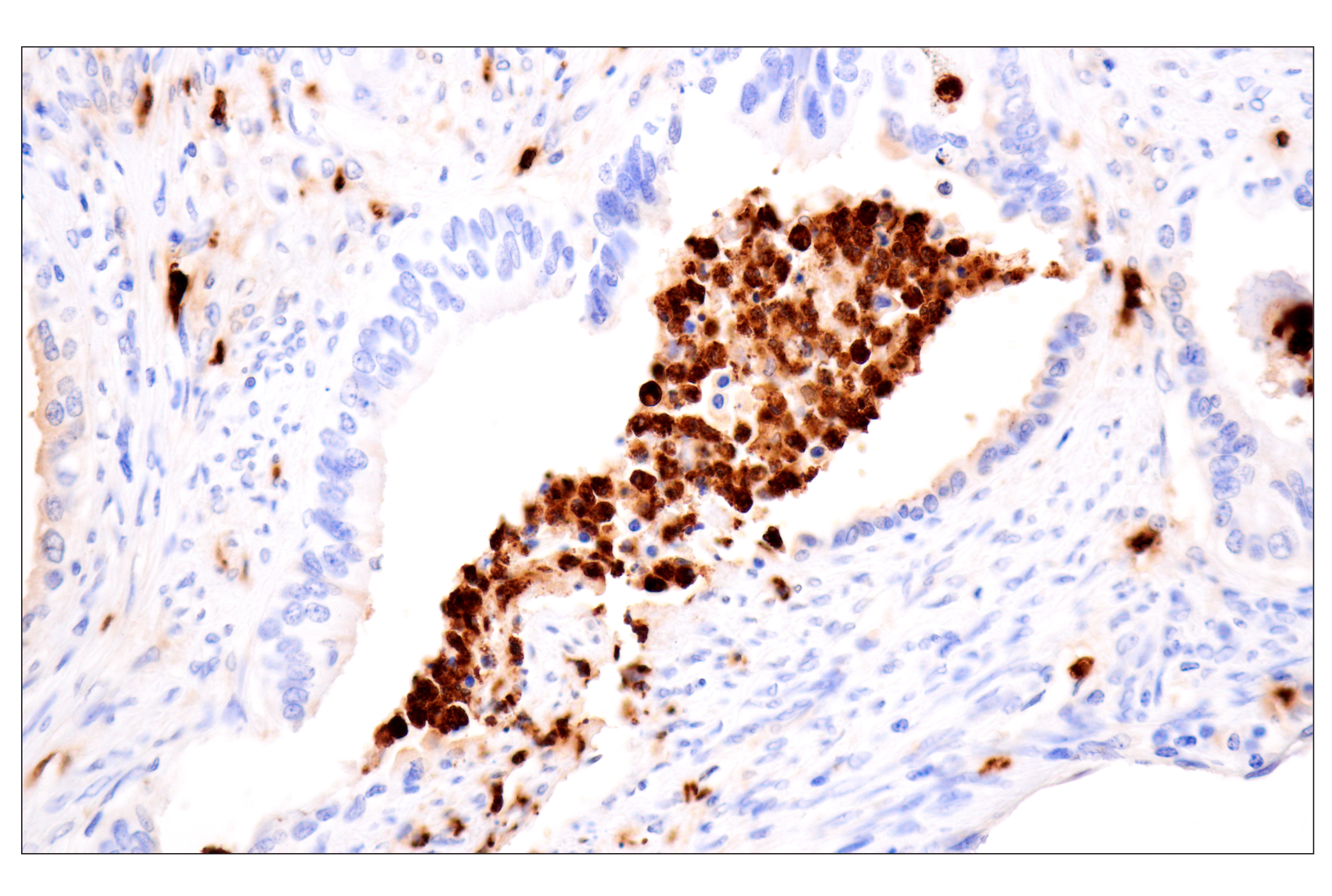Immunohistochemistry Image 2: Neutrophil Elastase (F4H3X) Rabbit mAb