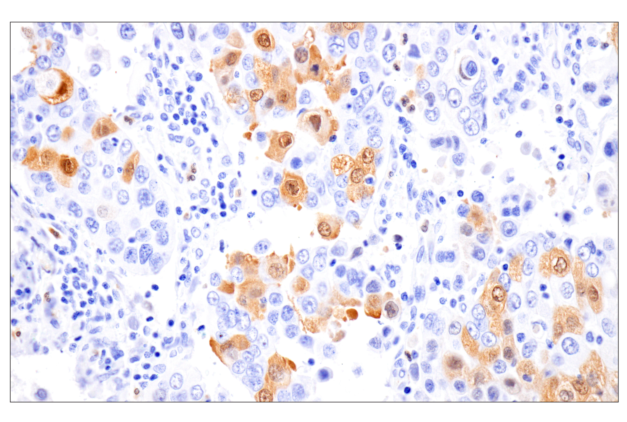 Immunohistochemistry Image 2: Phospho-Stat3 (Ser727) (D4X3C) Rabbit Monoclonal Antibody