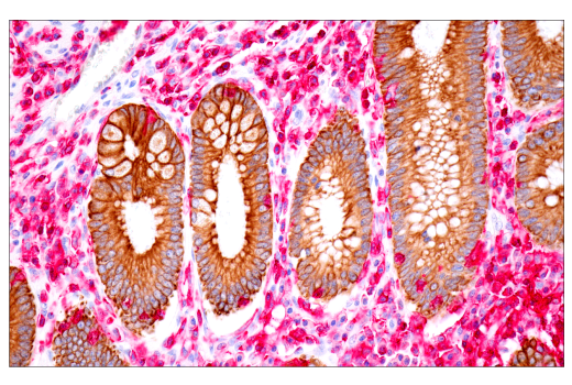 Immunohistochemistry Image 2: SignalStain® IHC Dual Staining Kit (AP, Rabbit, Red / HRP, Mouse, Brown)