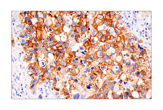 Immunohistochemistry Image 1: HER2/ErbB2 (D8F12) XP® Rabbit mAb