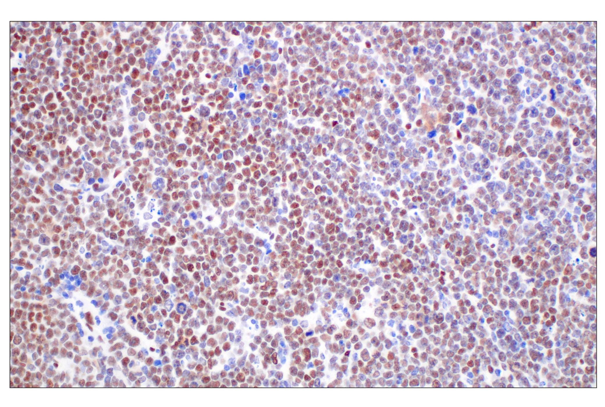 Immunohistochemistry Image 2: TCF4/ITF2 (E3X2Y) Rabbit mAb