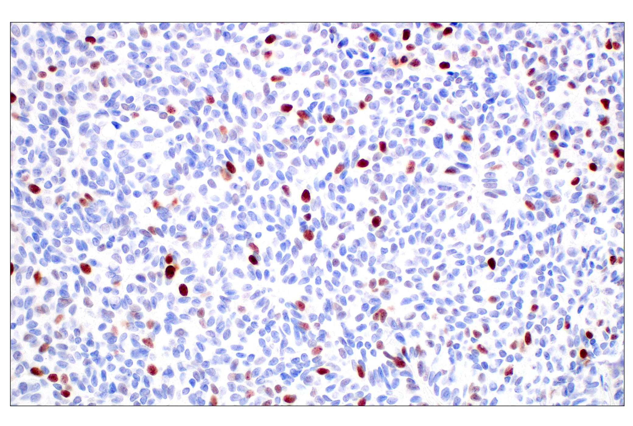 Immunohistochemistry Image 1: BRCA1 (E5S9G) Rabbit mAb