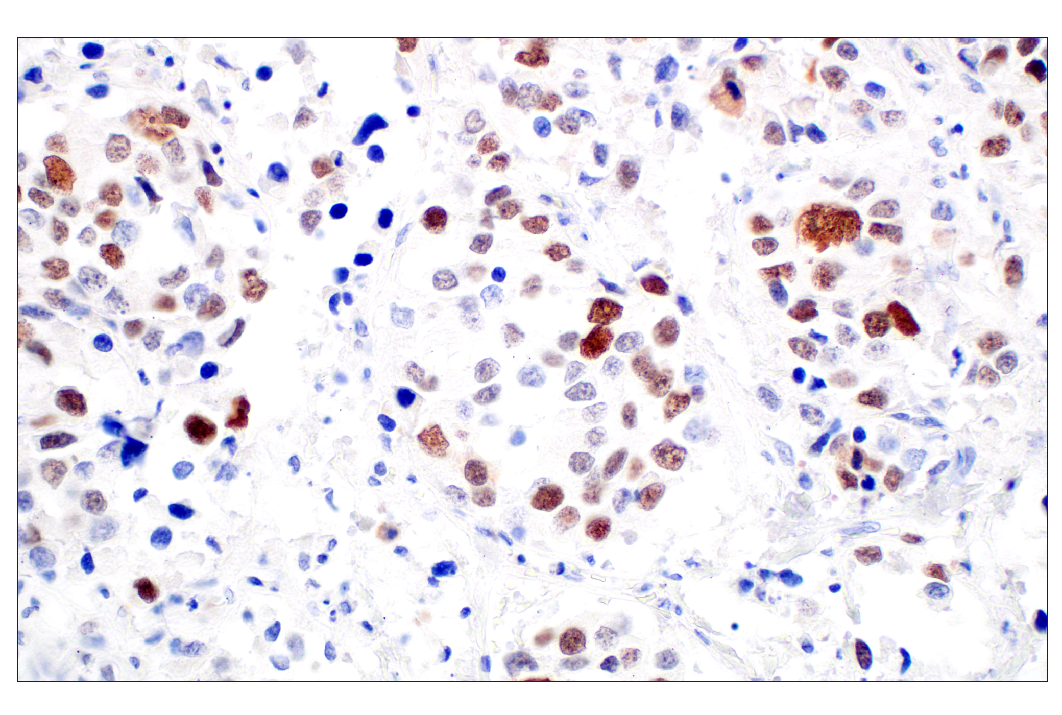 Immunohistochemistry Image 6: BRCA1 (E5S9G) Rabbit mAb