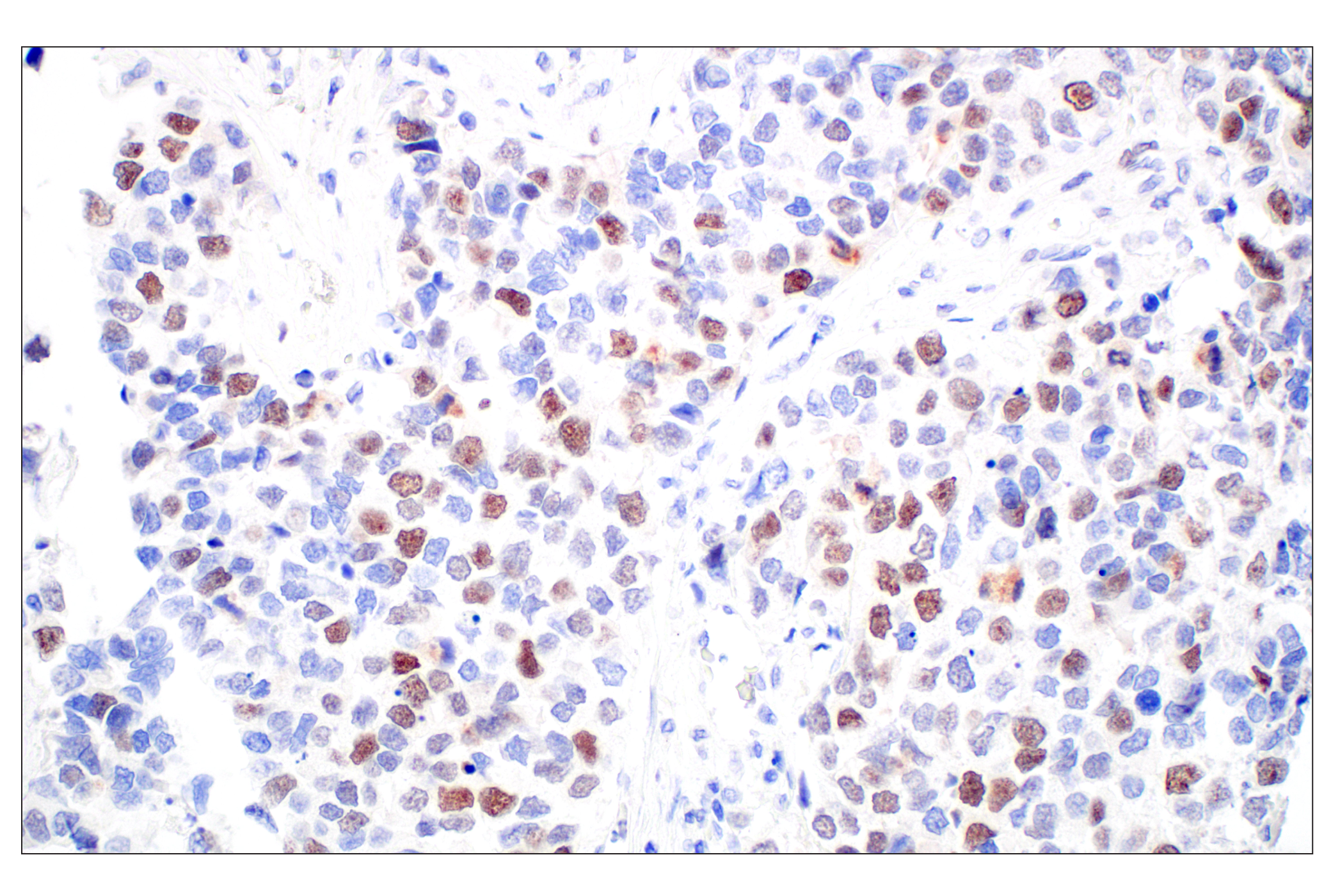 Immunohistochemistry Image 8: BRCA1 (E5S9G) Rabbit mAb
