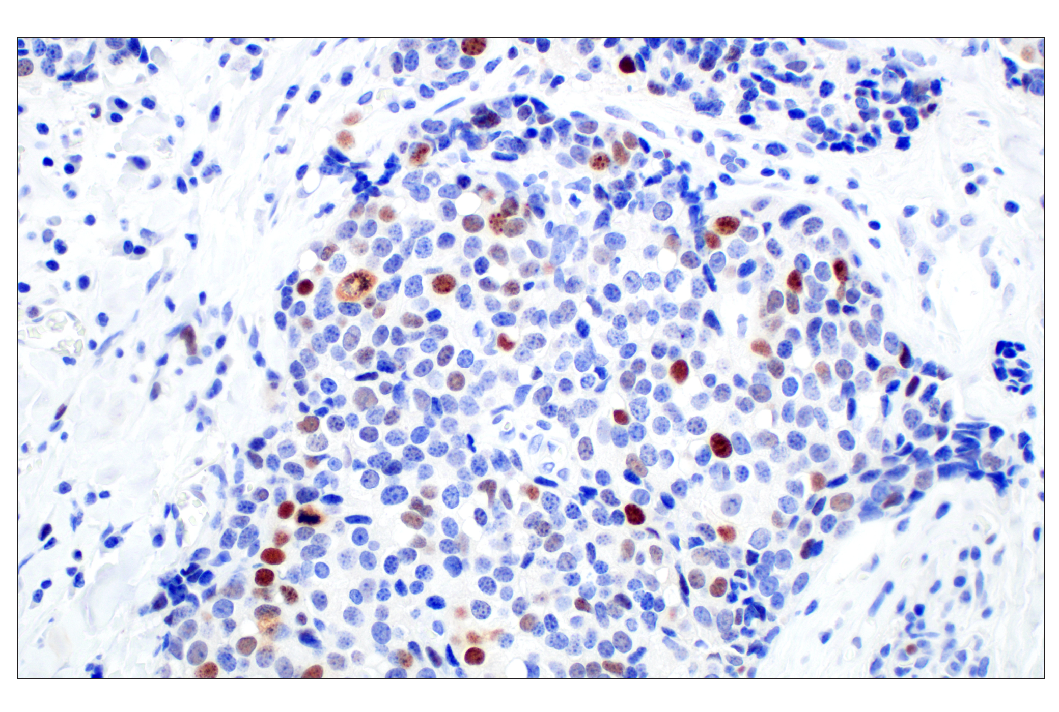 Immunohistochemistry Image 2: BRCA1 (E5S9G) Rabbit mAb