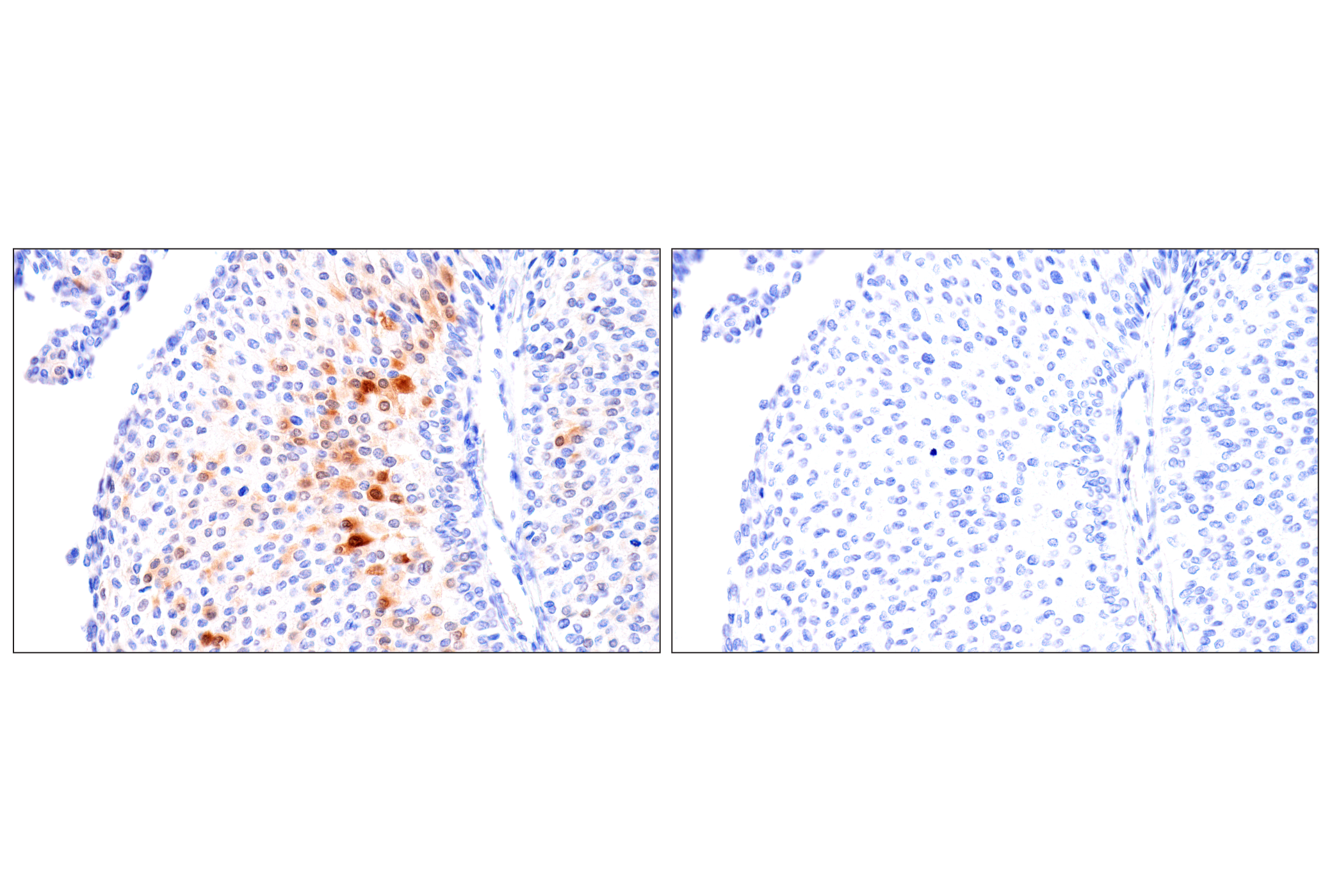 Immunohistochemistry Image 9: SERPINB3 (OTI1A12) Mouse mAb