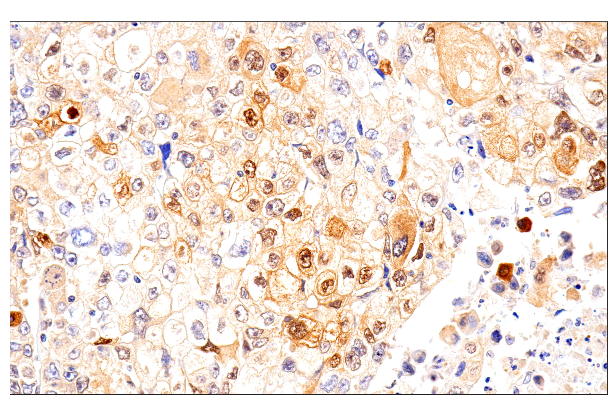 Immunohistochemistry Image 3: SERPINB3 (OTI1A12) Mouse mAb