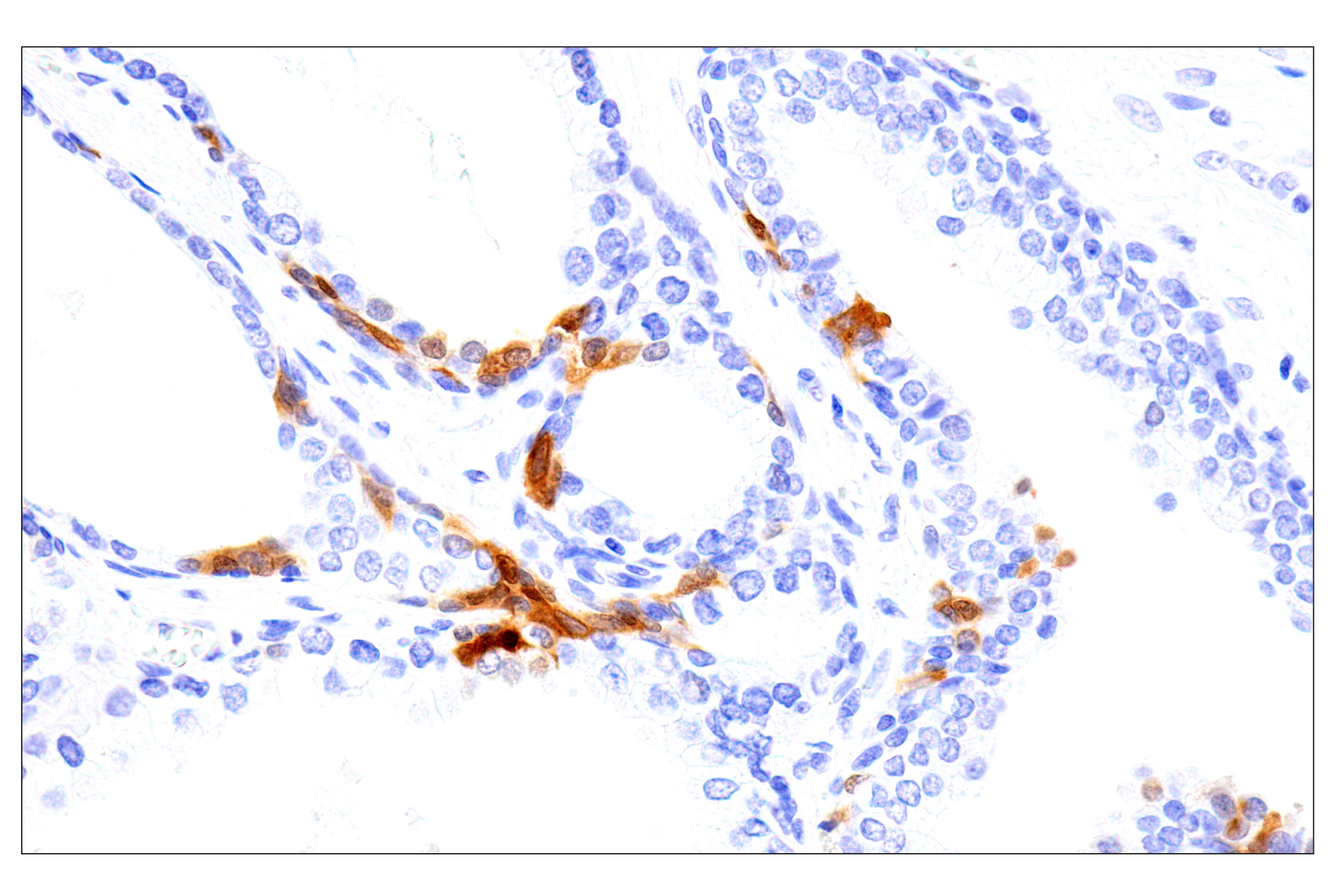 Immunohistochemistry Image 8: SERPINB3 (OTI1A12) Mouse mAb