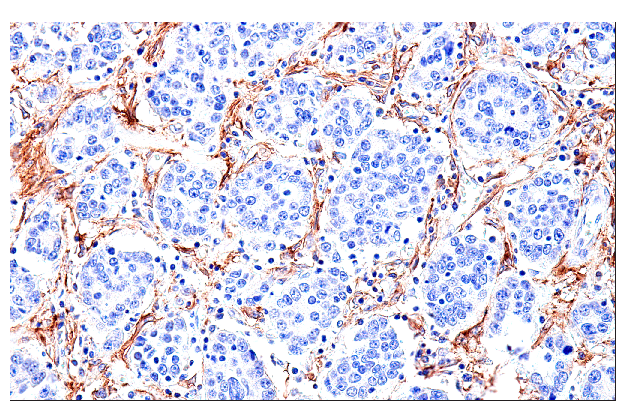 Immunohistochemistry Image 2: FAP (F1A4G) Rabbit mAb