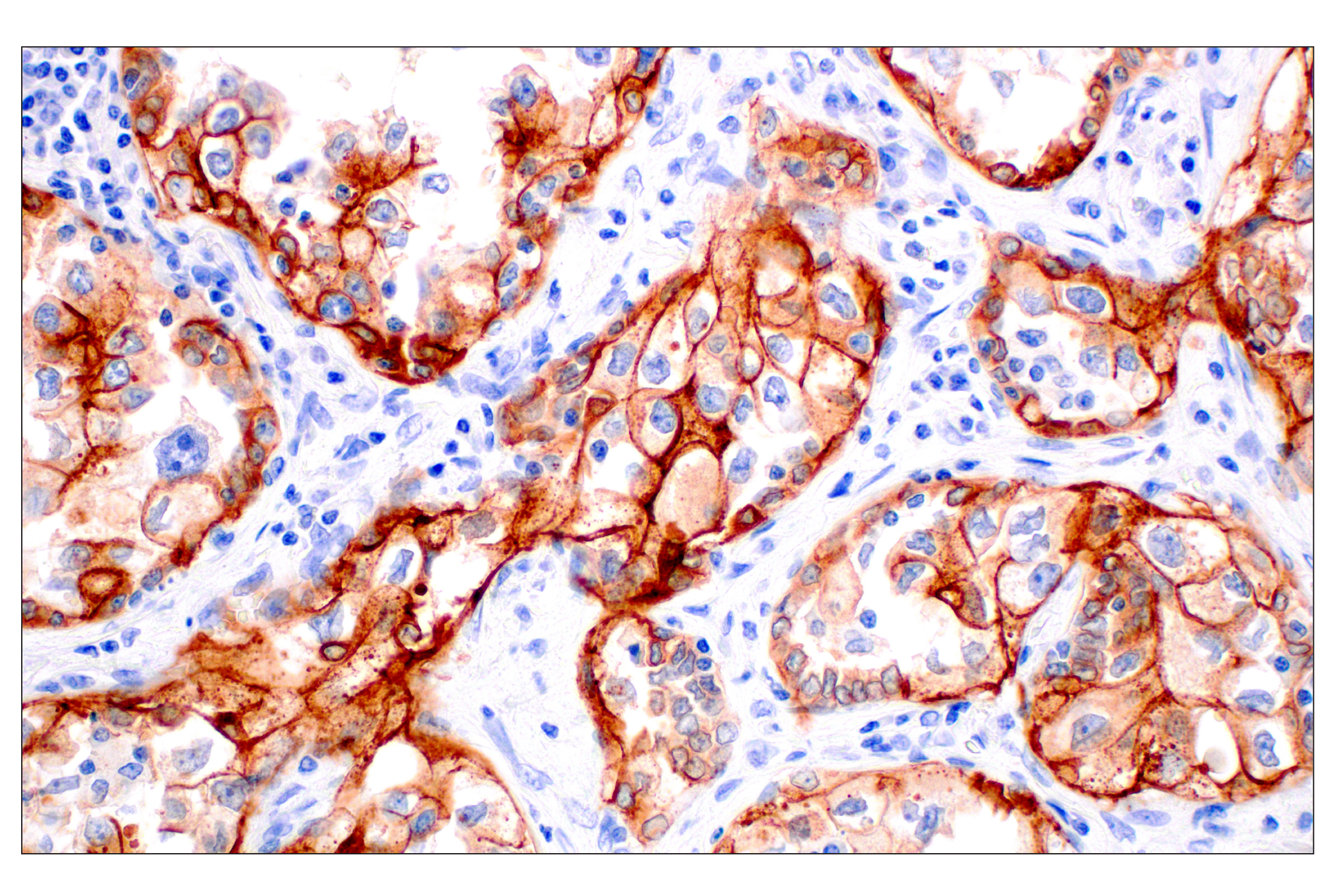 Immunohistochemistry Image 1: Integrin β6 (E4M9P) XP® Rabbit mAb (BSA and Azide Free)