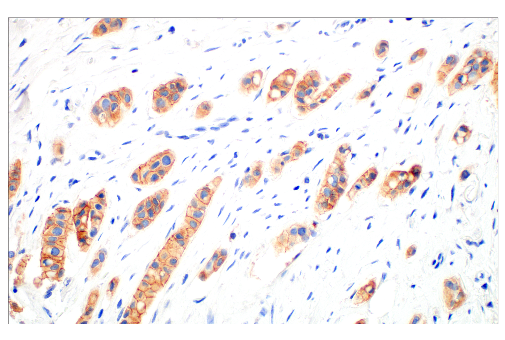 Immunohistochemistry Image 1: HER3/ErbB3 (D22C5) XP® Rabbit mAb (BSA and Azide Free)