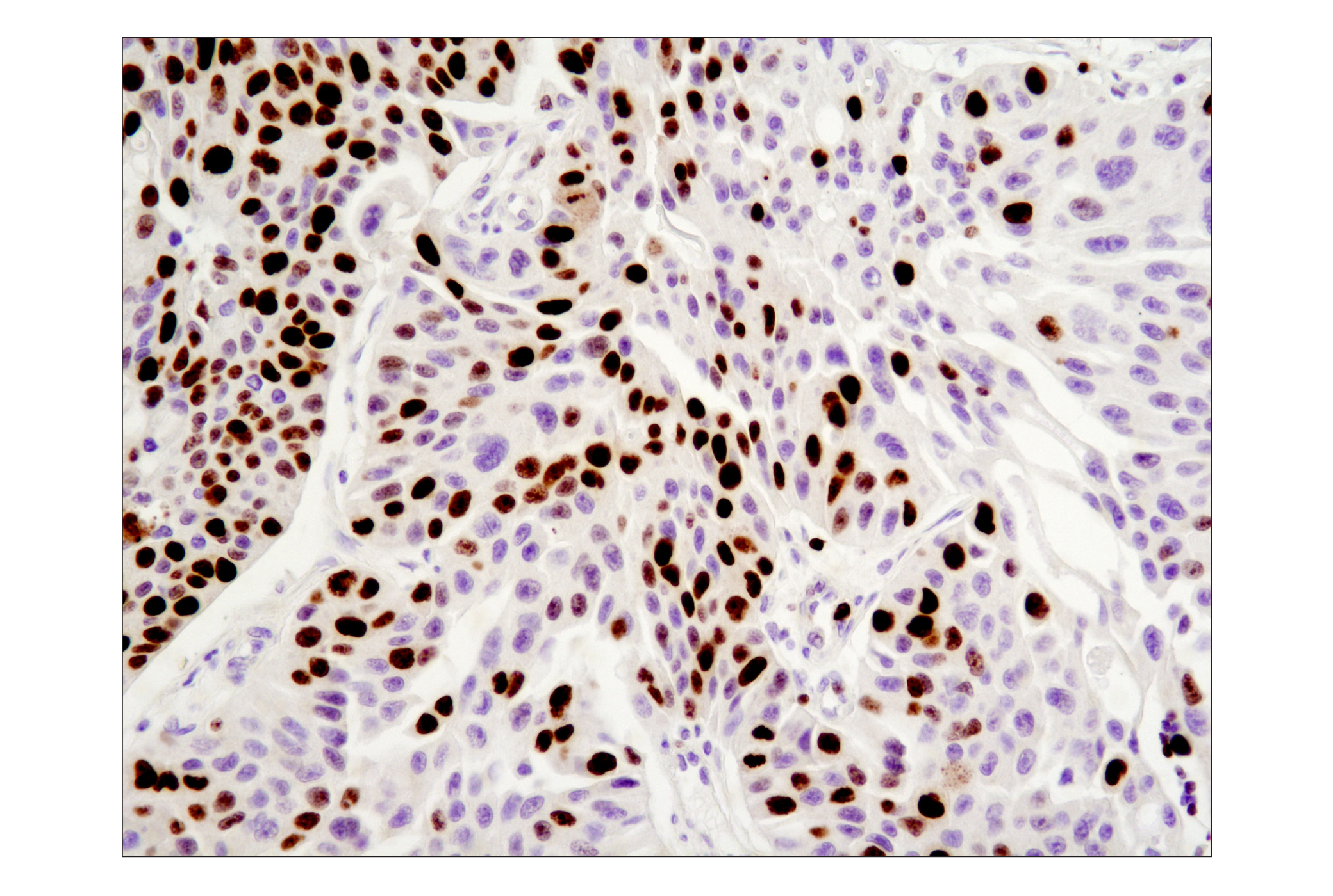 Immunohistochemistry Image 2: Ki-67 (8D5) Mouse mAb (BSA and Azide Free)