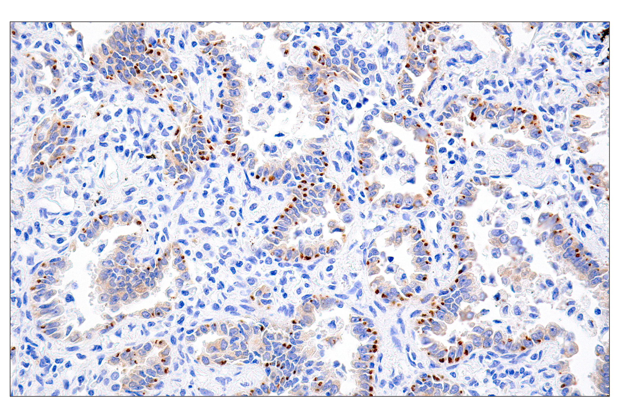 Immunohistochemistry Image 1: ROS1 (D4D6®) Rabbit mAb (Autostainer Formulated)