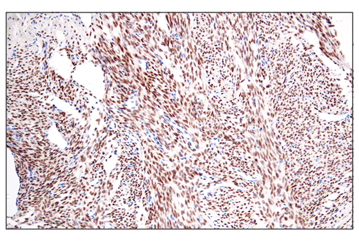 Immunohistochemistry Image 1: SS18-SSX (E9X9V) XP® Rabbit mAb