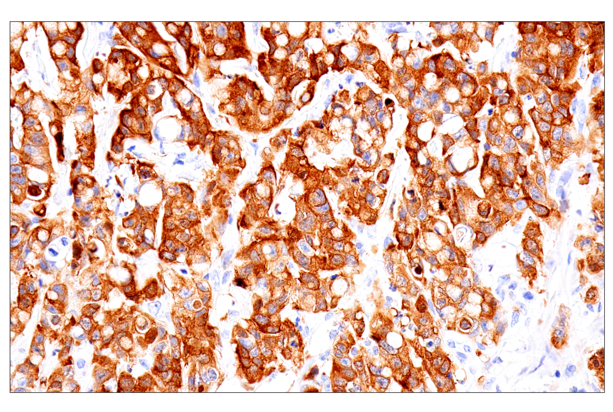 Immunohistochemistry Image 2: Asparagine Synthetase (E6C2C) XP® Rabbit mAb (BSA and Azide Free)