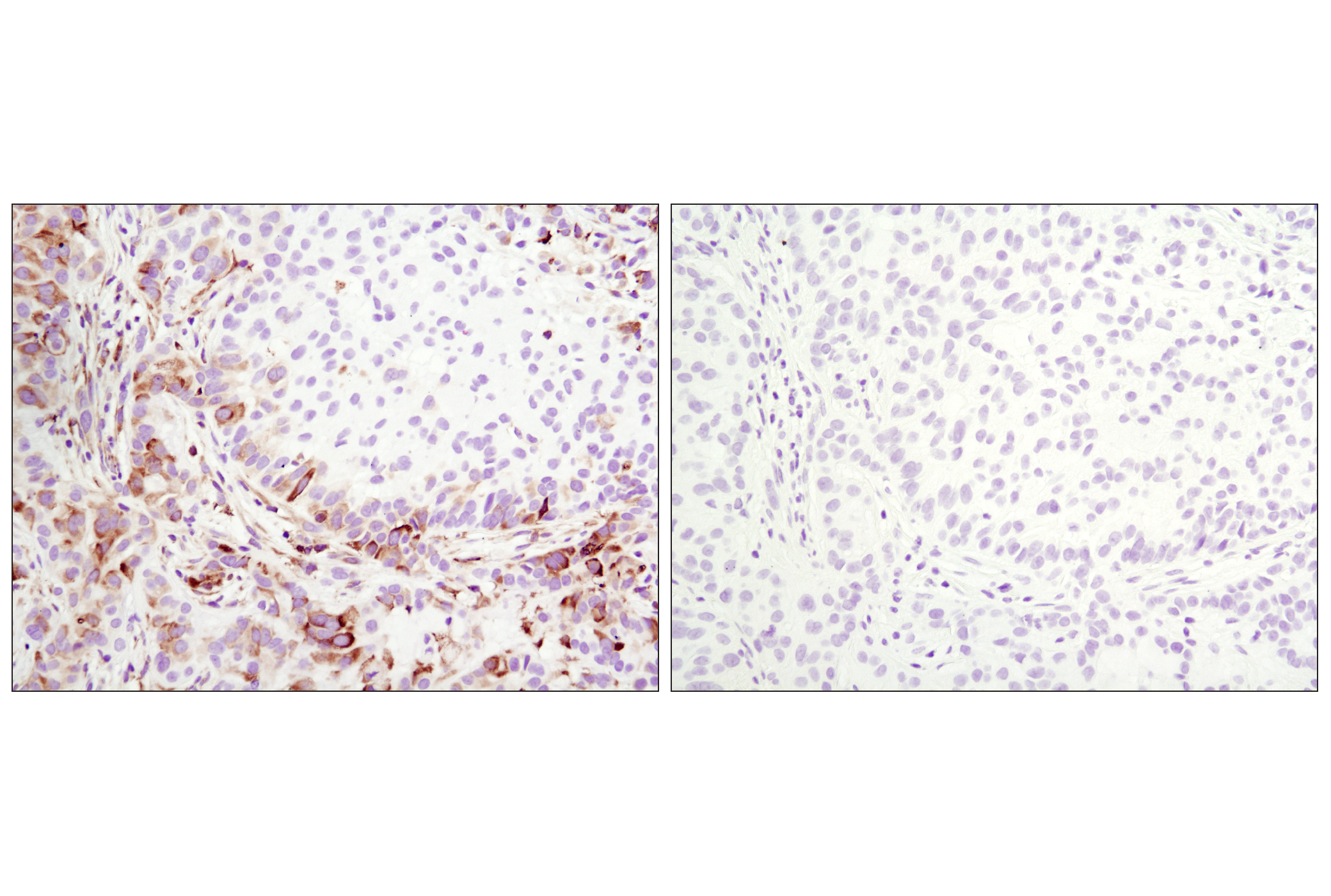 Immunohistochemistry Image 5: Phospho-S6 Ribosomal Protein (Ser235/236) (D57.2.2E) XP® Rabbit mAb (BSA and Azide Free)