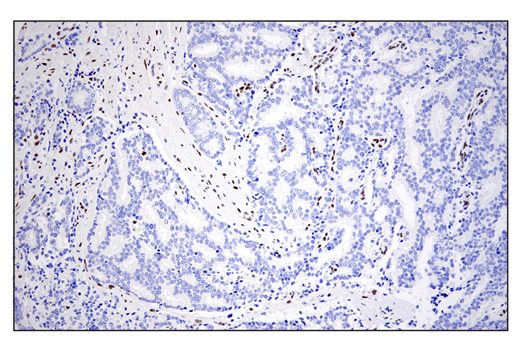 Immunohistochemistry Image 4: ZEB1 (E2G6Y) XP® Rabbit mAb (BSA and Azide Free)