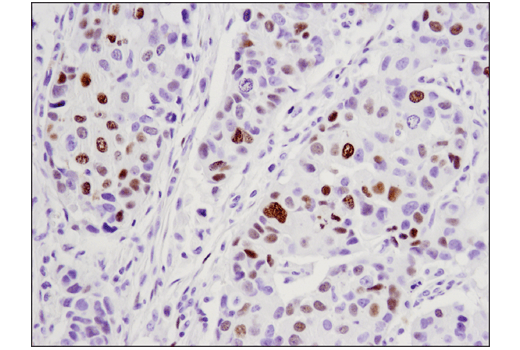 Immunohistochemistry Image 1: WT1 (D8I7F) XP® Rabbit mAb