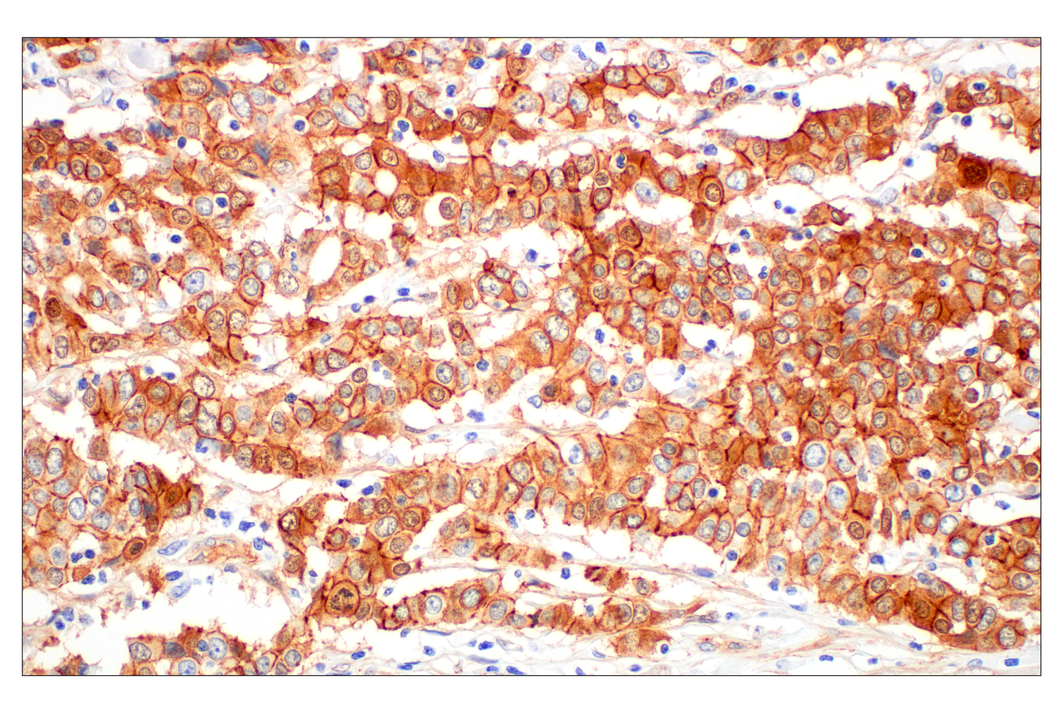 Immunohistochemistry Image 4: β-Catenin (D10A8) XP® Rabbit mAb