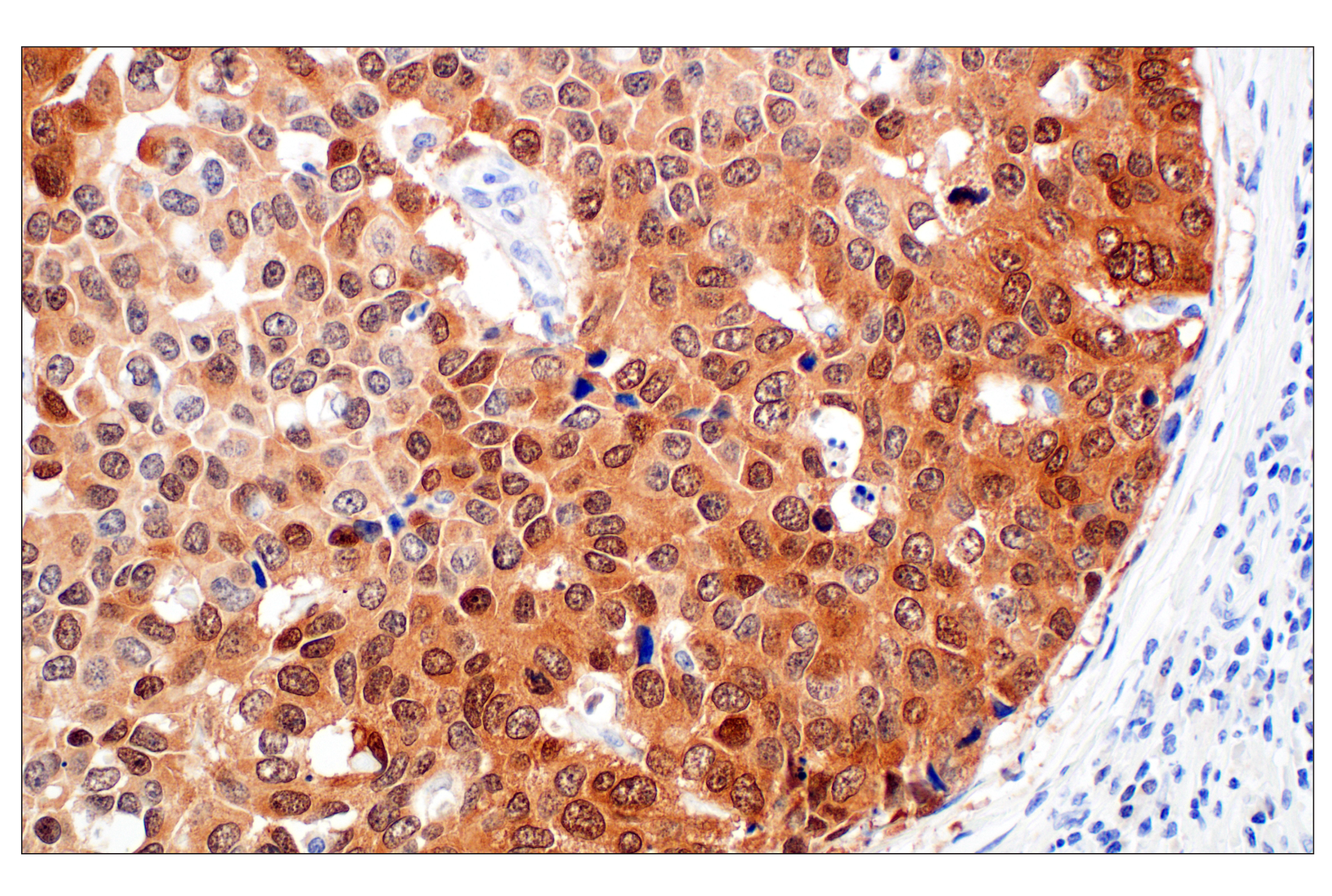 Immunohistochemistry Image 2: p16 INK4A (F9T1L) Rabbit Monoclonal Antibody