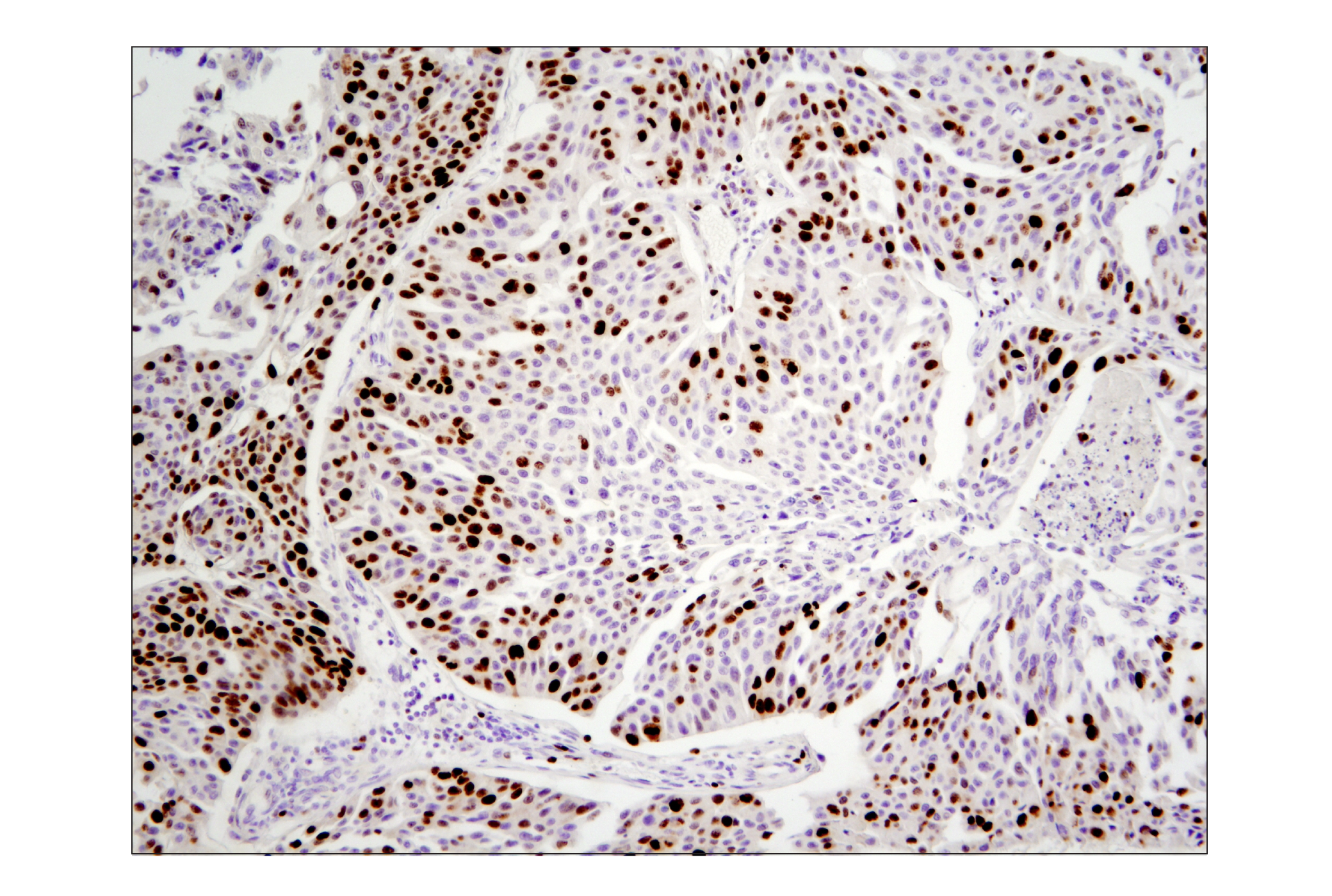 Immunohistochemistry Image 1: Ki-67 (D2H10) Rabbit mAb