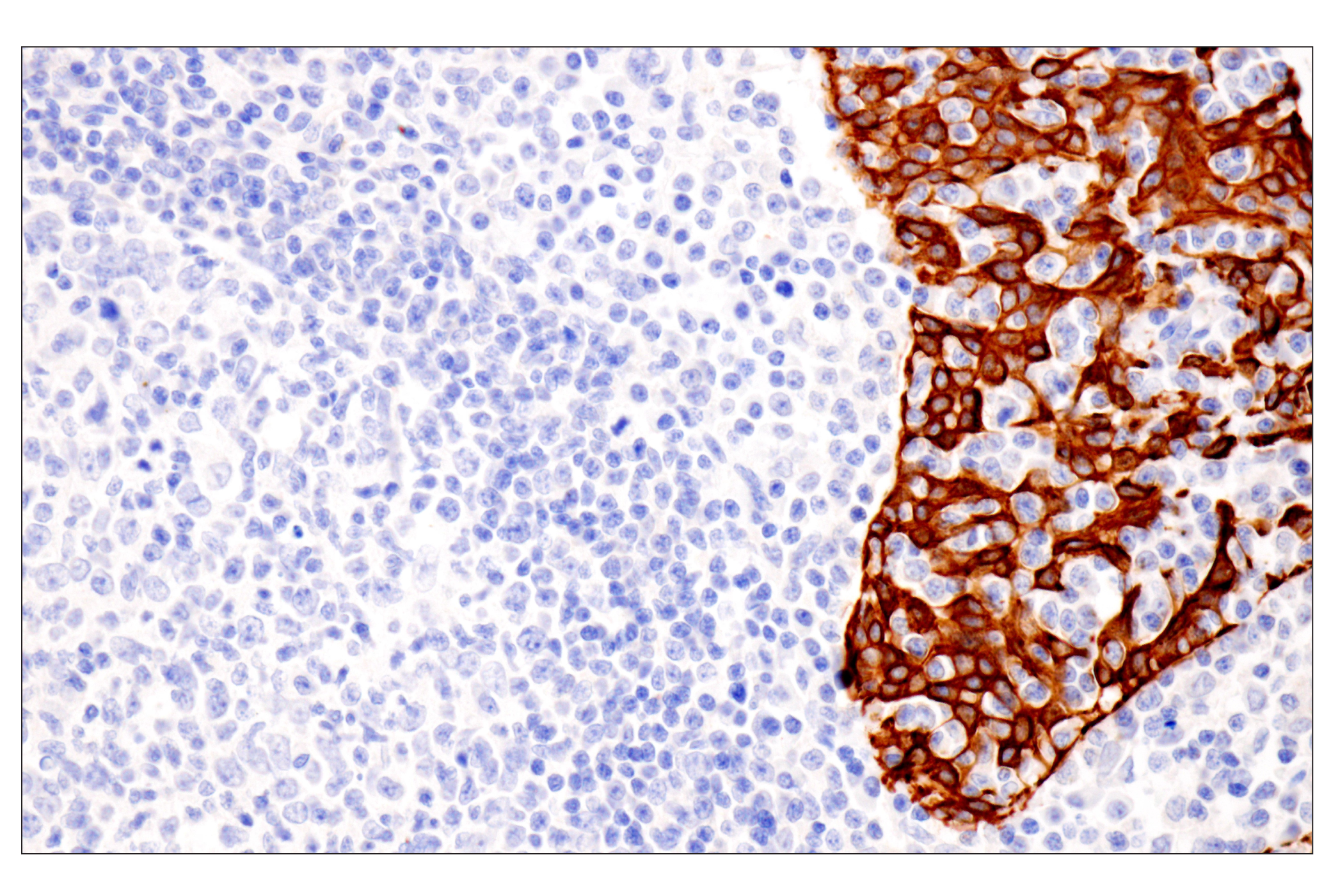 Immunohistochemistry Image 11: Pan-Keratin (Type II) (F6G1P) Rabbit Monoclonal Antibody