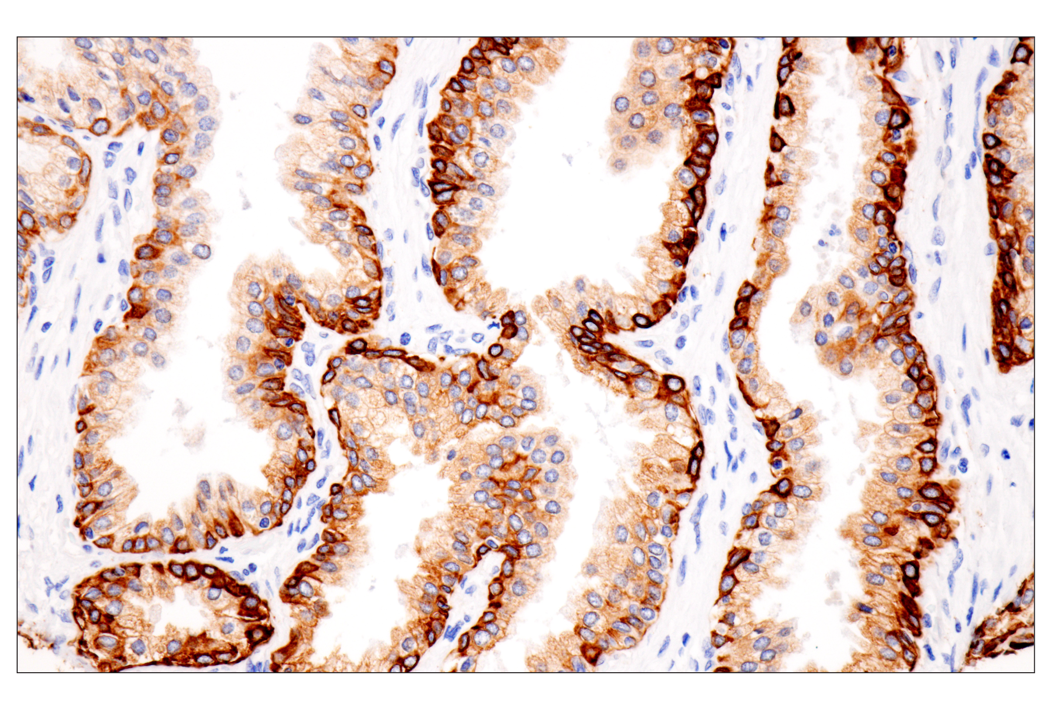 Immunohistochemistry Image 2: Pan-Keratin (Type II) (F6G1P) Rabbit Monoclonal Antibody