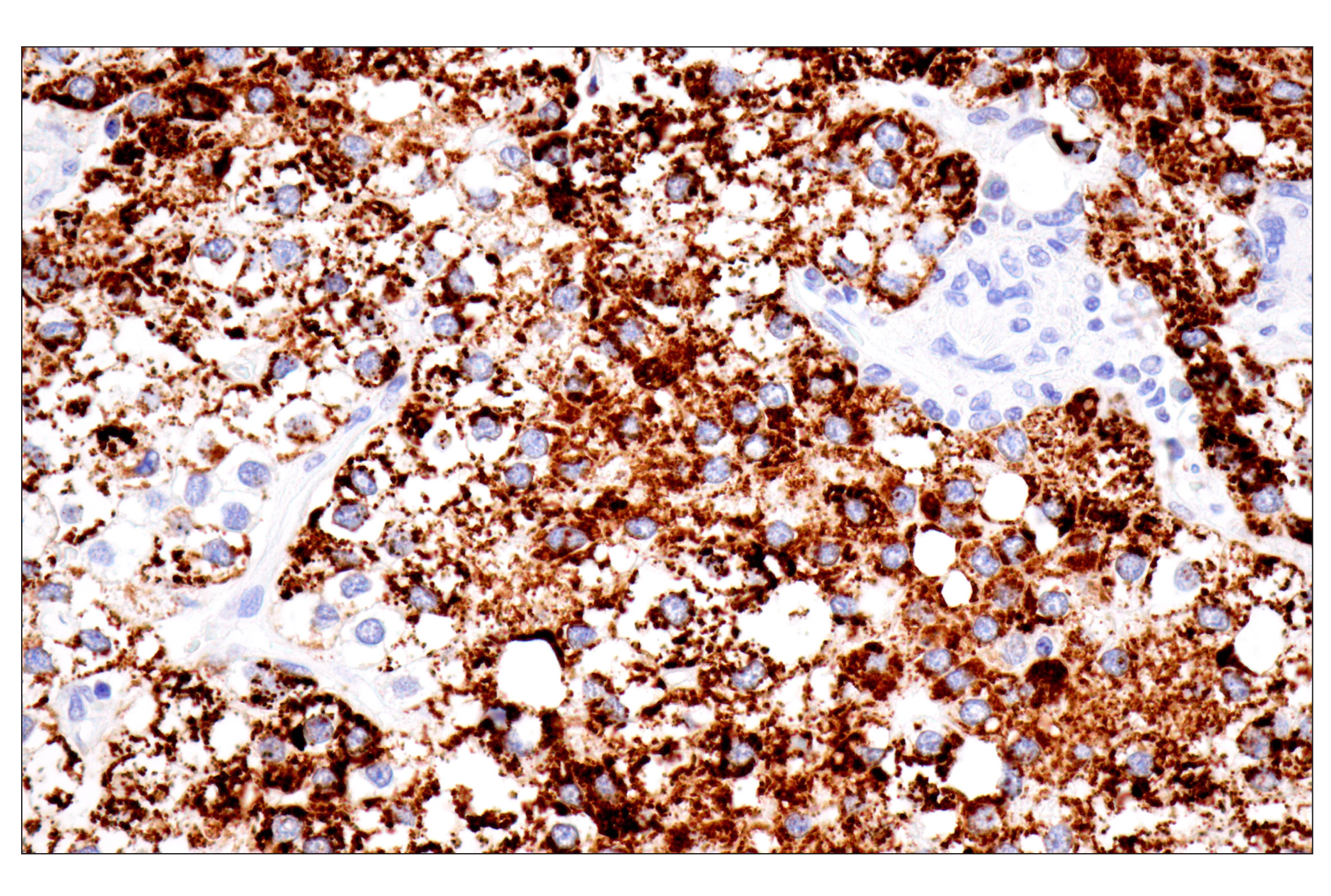 Immunohistochemistry Image 2: CPS1/Hep Par-1 (OCH1E5) Mouse mAb (Clone previously known as Hepatocyte Specific Antigen)