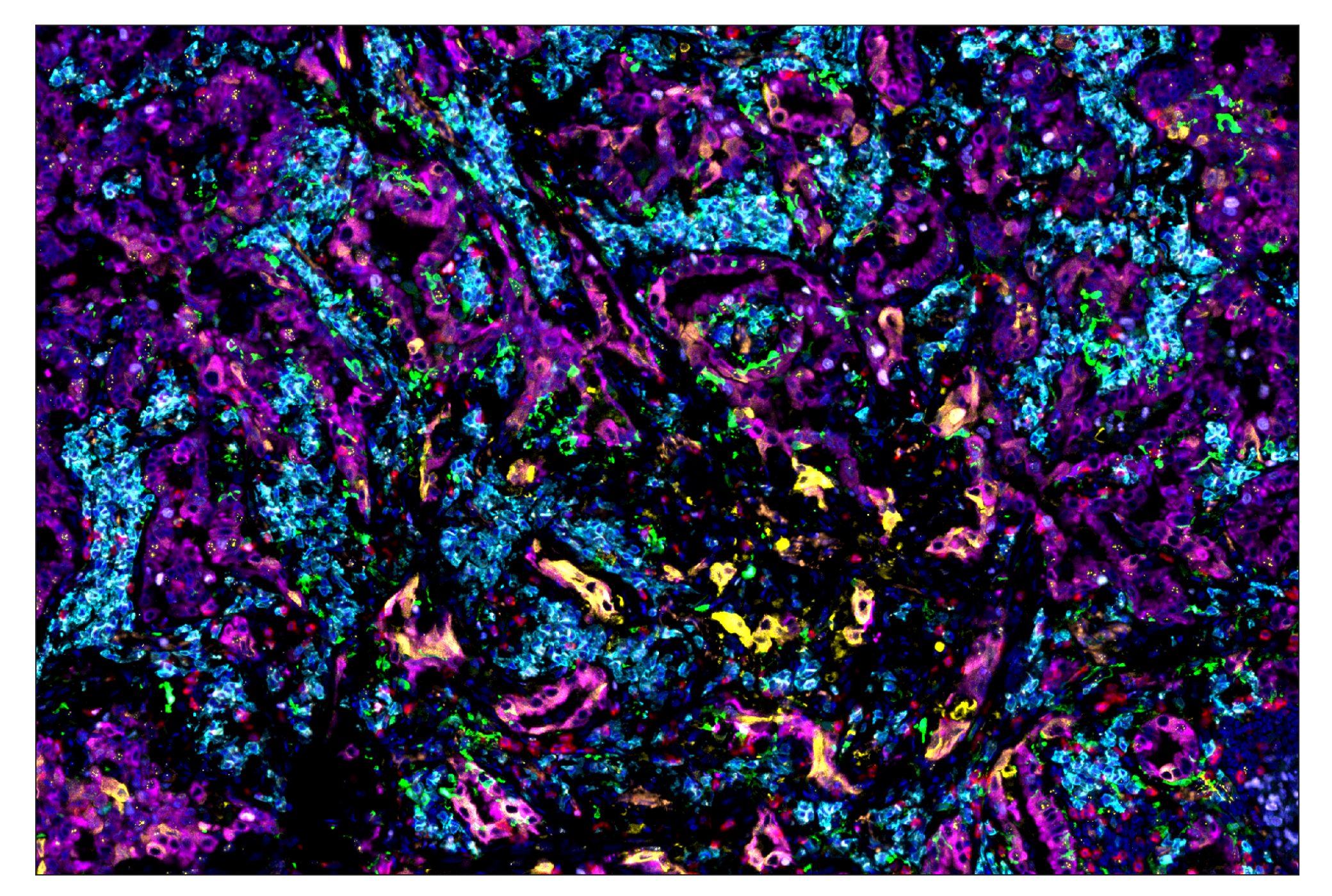 Image showing SignalStar multiplex immunohistochemical analysis of paraffin-embedded human lung adenocarcinoma.