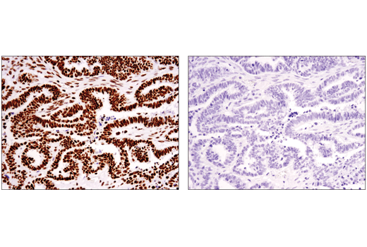 パラフィン包埋したヒト卵巣漿液性乳頭がんを、非メチル化ペプチド (左) あるいはK36トリメチル化ペプチド (右) の存在下でTri-Methyl-Histone H3 (Lys36) (D5A7) を用いて免疫組織化学染色で解析しました。