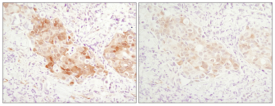 Comparison of immunohistochemical staining of paraffin-embedded
        human breast carcinoma tissue using SignalStain® Antibody Diluent #8112 and TBST/5%
        normal goat serum.