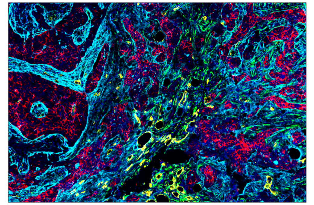 SignalStar oligo-based multiplex immunohistochemical analysis of paraffin-embedded human infiltrating ductal carcinoma of the breast. 