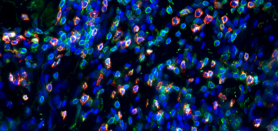 Immunohistochemical analysis of paraffin-embedded human colon adenocarcinoma.