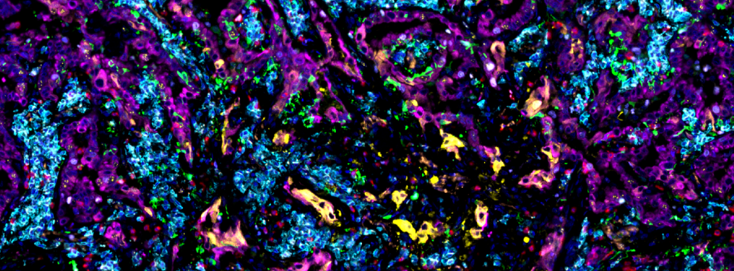 Image showing SignalStar multiplex immunohistochemical analysis of paraffin-embedded human lung adenocarcinoma.