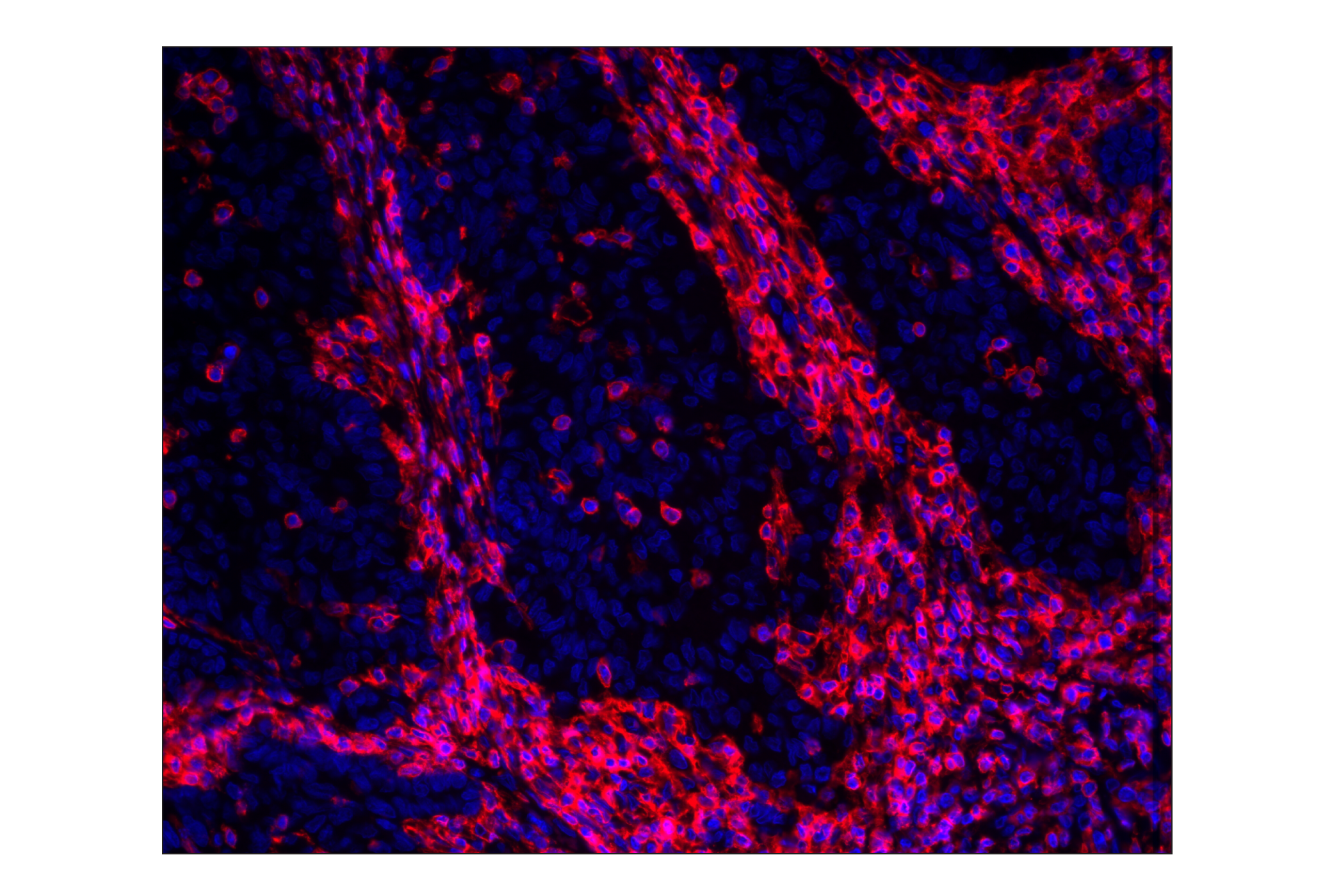 Immunohistochemical analysis of paraffin-embedded human colon adenocarcinoma using CD45 (Intracellular Domain) (D9M8I) XP® Rabbit mAb (Alexa Fluor® 647 Conjugate) (red) and DAPI #4083 (blue).