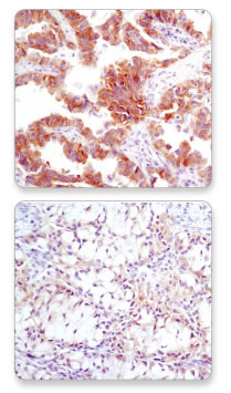 IHC Analysis of ALK Expression